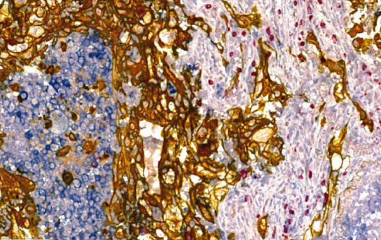 Lung Adenocarcinoma: PD-L1, CD8, PanCK (2). PD-L1 on both macrophages & cancer tissue.